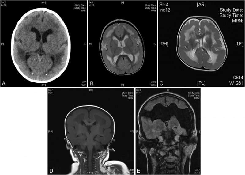 Cerebral Palsy Ct Scan
