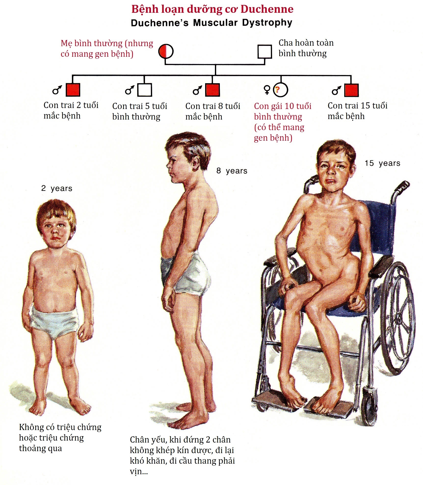 Loạn dưỡng cơ – Duchenne -3