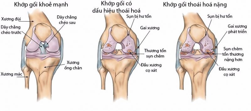 Thoái Hóa Khớp Gối - Phương Pháp Điều Trị Phục Hồi Hiệu Quả