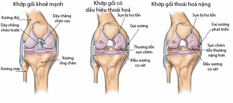 Kết quả hình ảnh cho THOÁI HÓA KHỚP