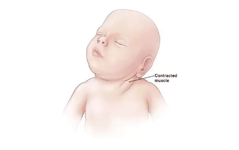 Xo Hoa Co Uc Don Chum