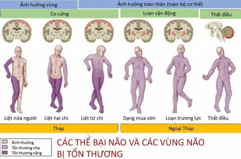 Infographic về các thể bại não và vùng bị tổn thương
