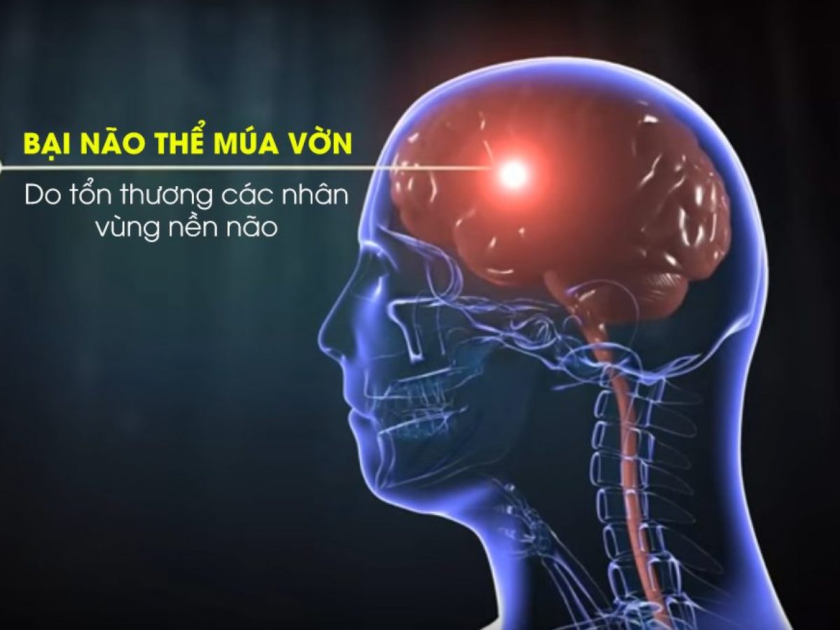 Bại Não Thể Múa Vờn: Khái Niệm, Biểu Hiện, Nguyên Nhân