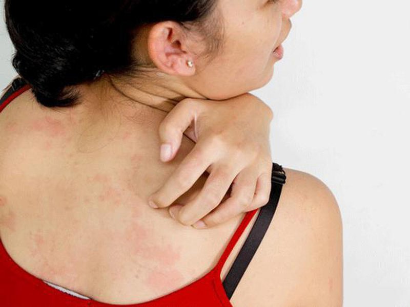 Bệnh làm ảnh hưởng không nhỏ đến chất lượng cuộc sống Bệnh làm ảnh hưởng không nhỏ đến chất lượng cuộc sống