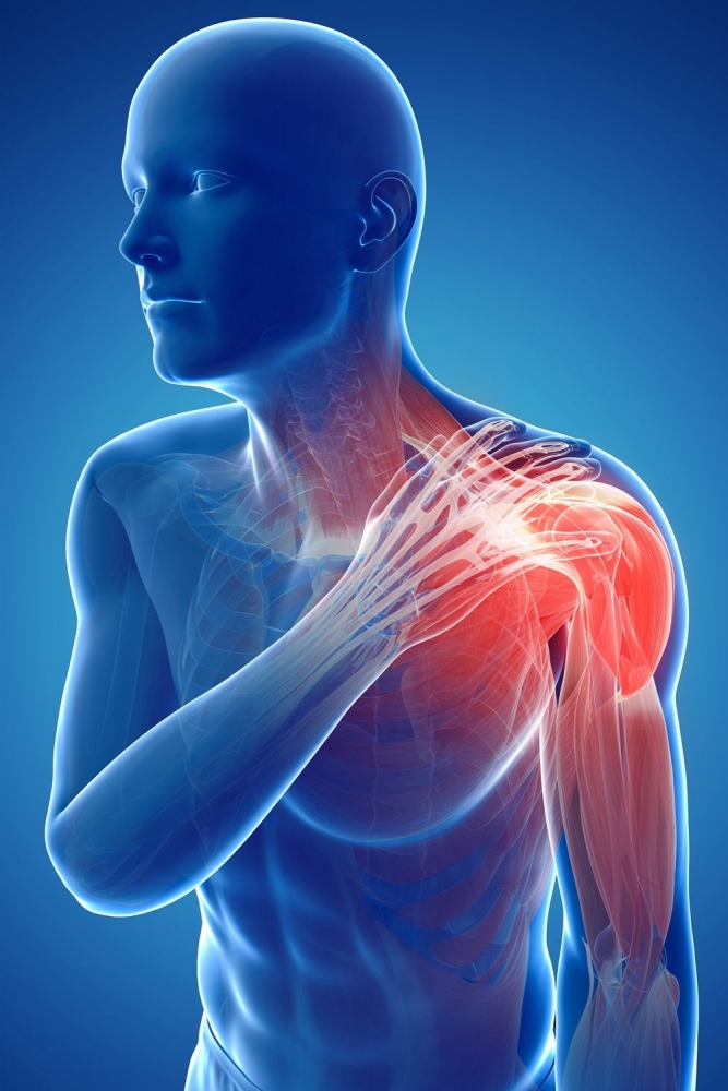 Đau cổ vai gáy là bệnh lý liên quan đến rối loạn thần kinh cơ Đau cổ vai gáy là bệnh lý liên quan đến rối loạn thần kinh cơ