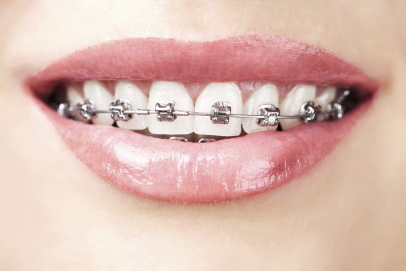Khi niềng răng cần tìm đến địa chỉ uy tín Khi niềng răng cần tìm đến địa chỉ uy tín