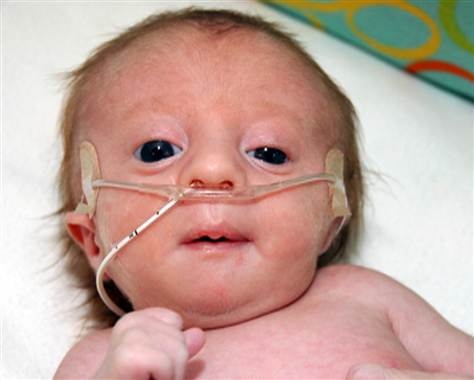 edwards syndrome