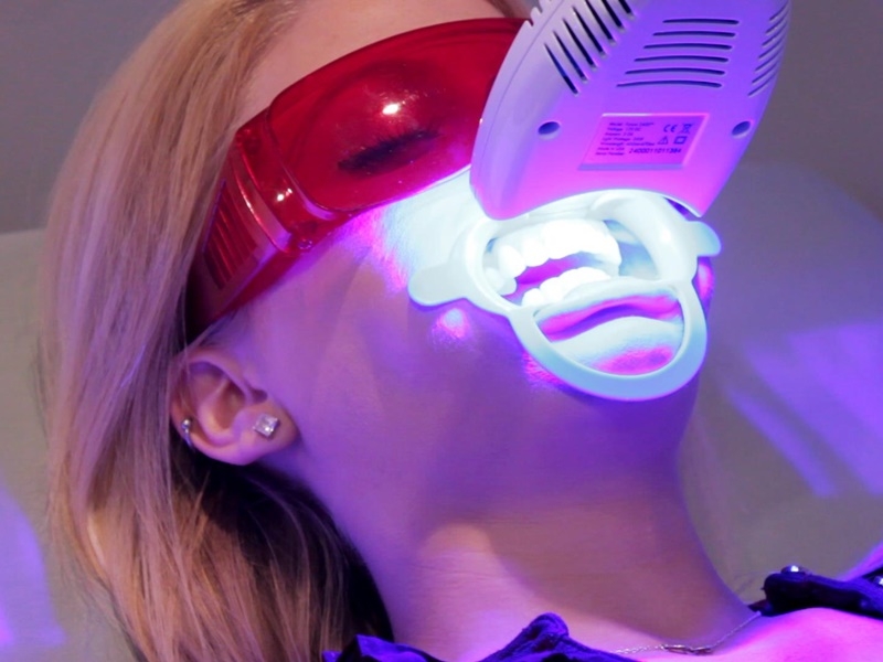 Công nghệ tẩy trắng răng bằng Laser Whitening