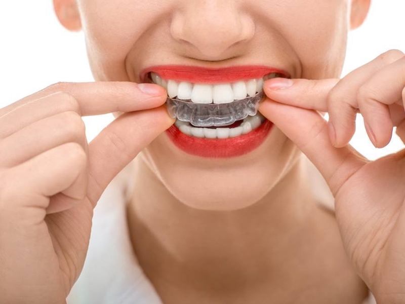 Tẩy trắng răng tại nhà với máng