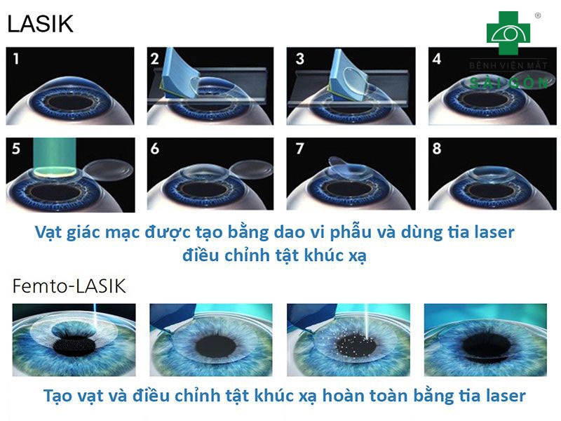Phương pháp mổ mắt cận thị Lasik