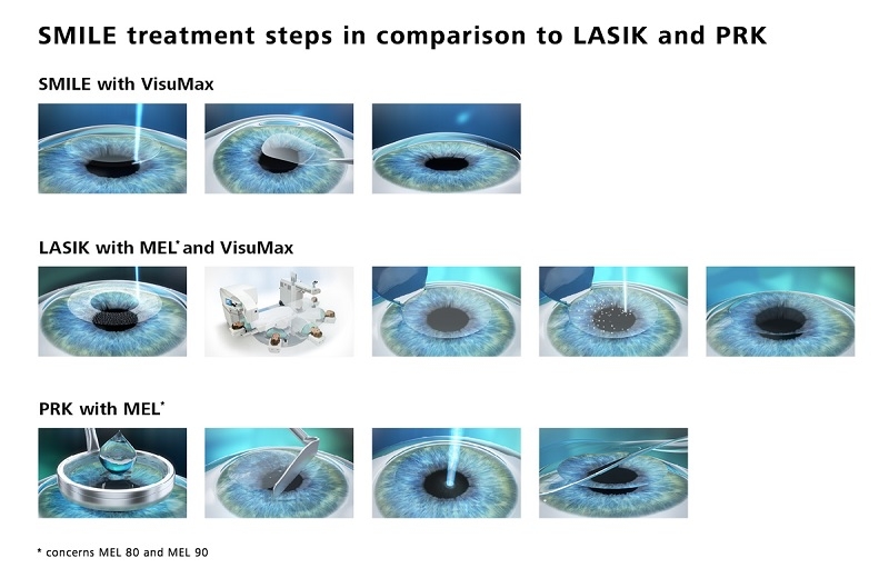 Điểm khác biệt giữa phương pháp mổ mắt cận Relex và Lasik