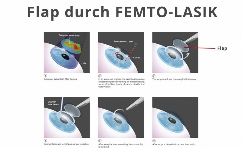 Phương pháp mổ mắt cận thị Femto LASIK không sử dụng đến dao phẫu thuật