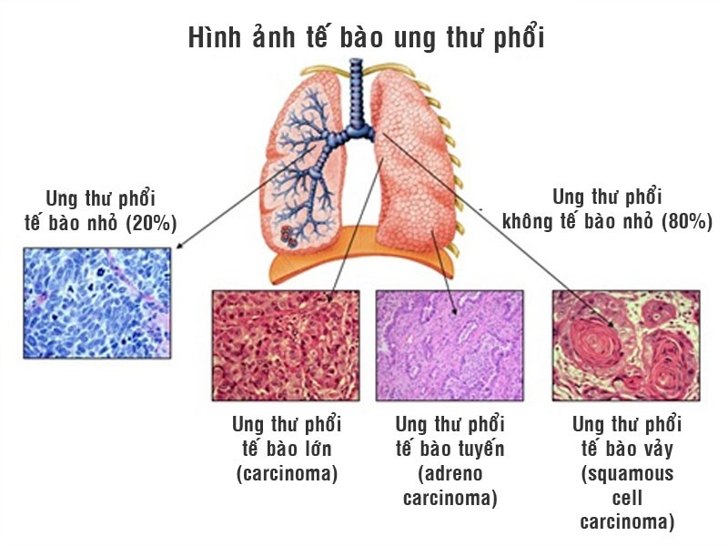 Ung thư phổi có 10% do yếu tố di truyền