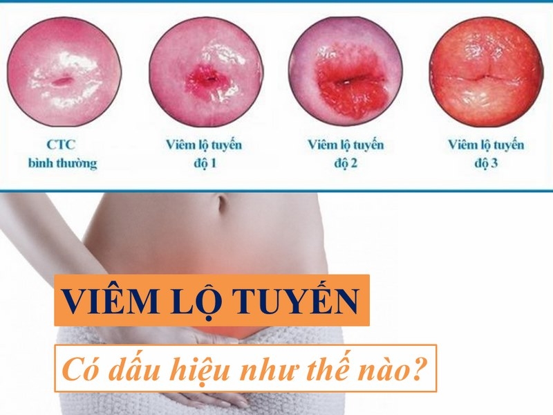 Các cấp độ của viêm lộ tuyến cổ tử cung