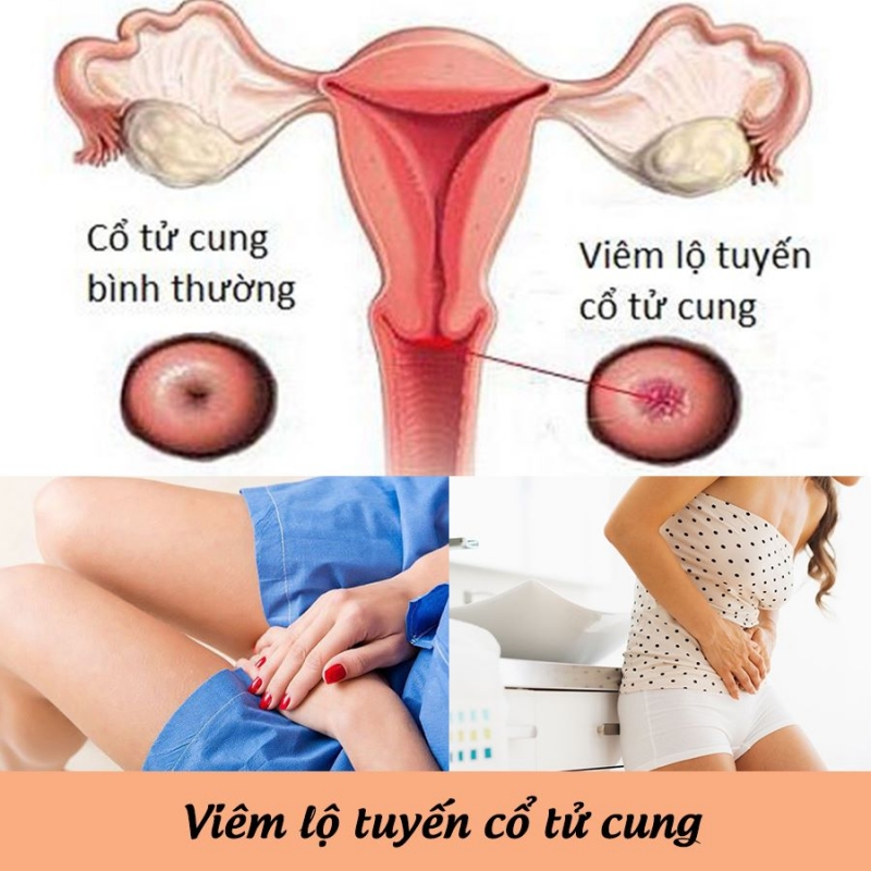 Viêm lộ tuyến ở cổ tử cung do các loại vi khuẩn gây nên