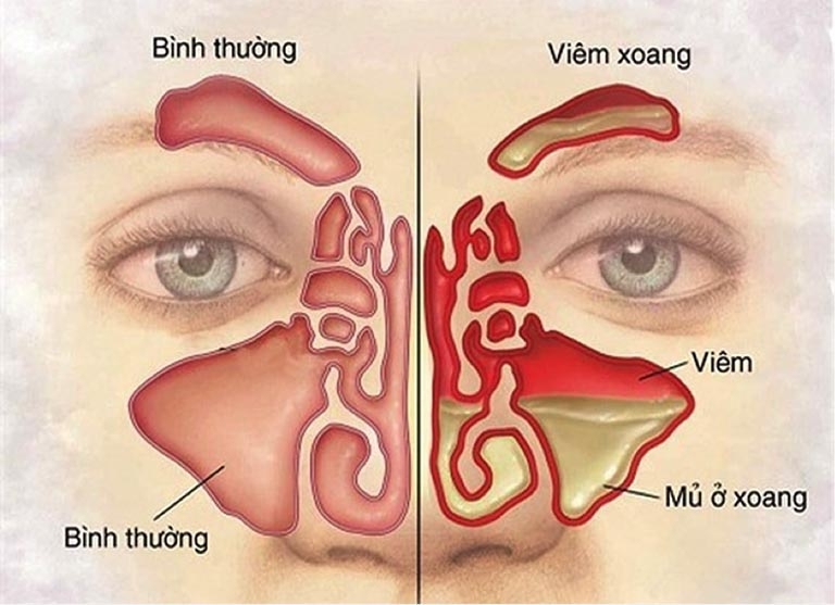 Triệu chứng của bệnh viêm xoang 