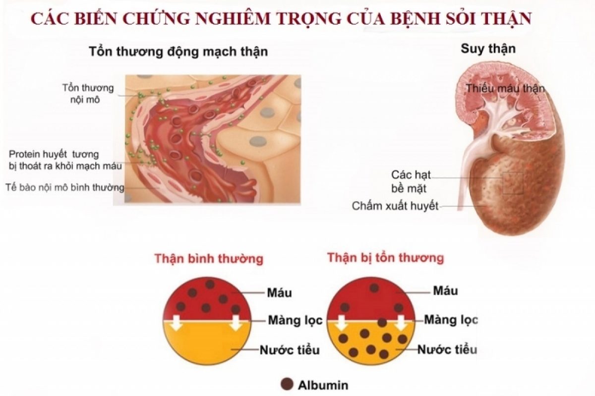 Cây Kim tiền thảo có chữa được sỏi thận không?