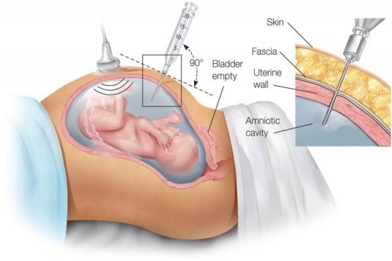 chọc ối xét nghiệm