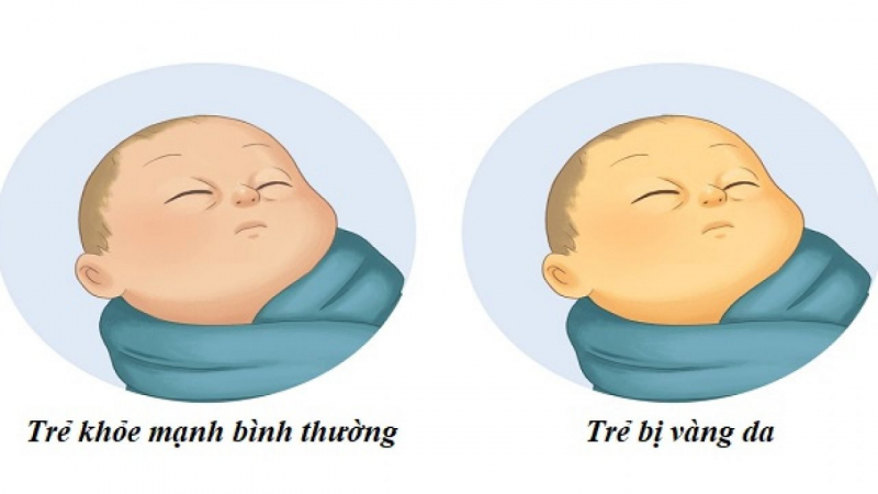 Vàng da sơ sinh đang là mối lo ngại với nhiều bậc phụ huynh. Đây là tình trạng thường gặp ở trẻ sơ sinh ngay từ những ngày đầu vừa trào đời của trẻ. Tuy tỉ lệ để lại các di chứng nặng nề không cao nhưng cũng không thể chủ quan. 