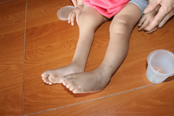 Teo cơ tủy sống ở trẻ em là gì