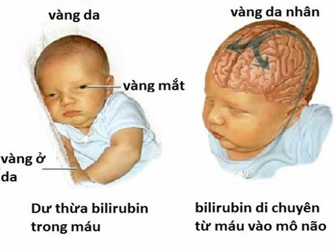 Ngoài ra, bệnh vàng da cũng có thể dẫn đến biến chứng vàng da nhân não ở trẻ. Nó có thể để lại nhiều di chứng khiến trẻ chậm phát triển; mà tệ hơn là có thể dẫn tới tử vong.