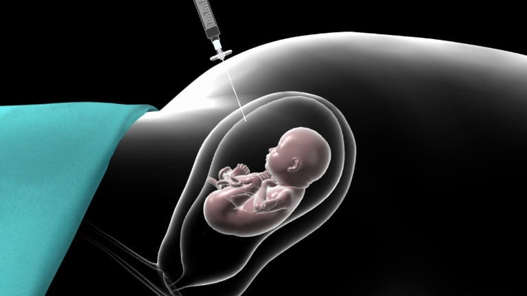 nhược điểm của xét nghiệm nipt
