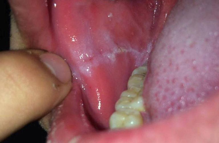 xét nghiệm ADN bằng niêm mạc miệng