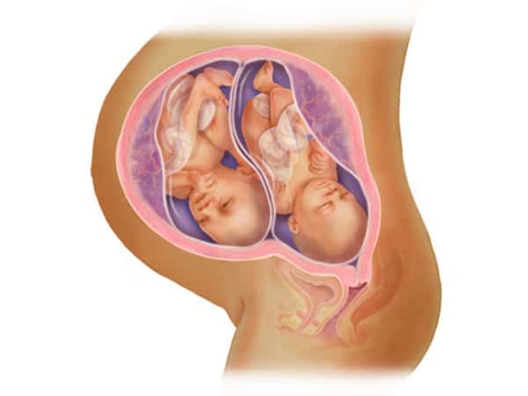 xét nghiệm nipt cho thai đôi