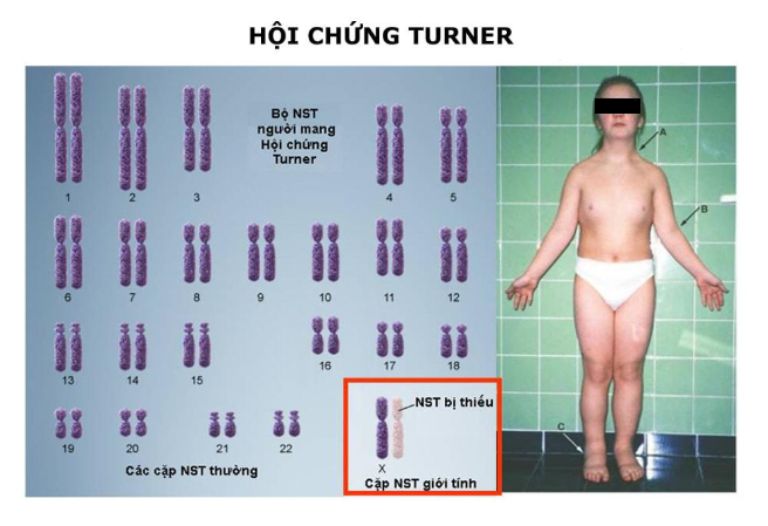 Hội chứng Turner