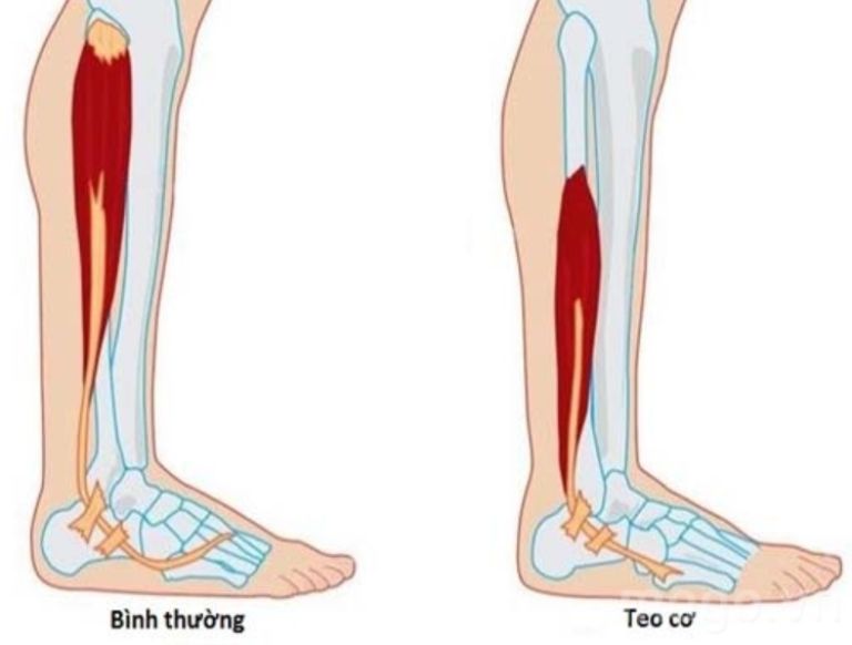 Bệnh teo cơ Duchenne