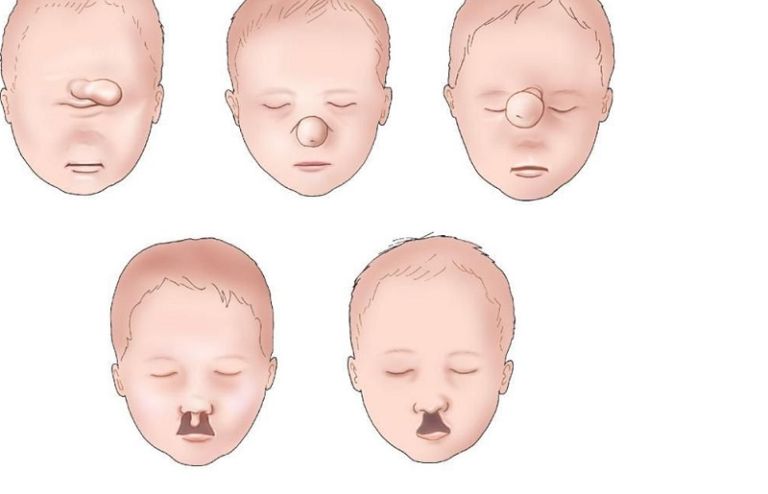 Hội chứng Patau (trisomy 13)