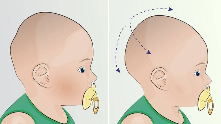 Hội chứng Cri du chat