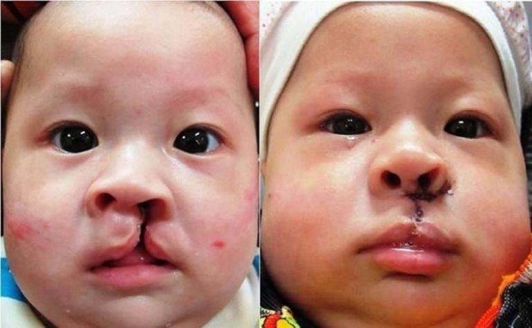 Khả năng sàng lọc hội chứng, dị tật của hai phương pháp