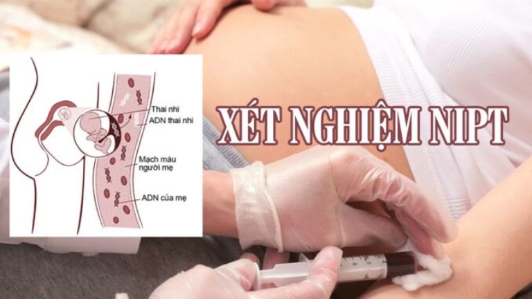 Xét nghiệm NIPT