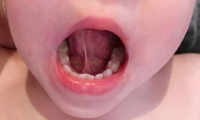 dính thắng lưỡi