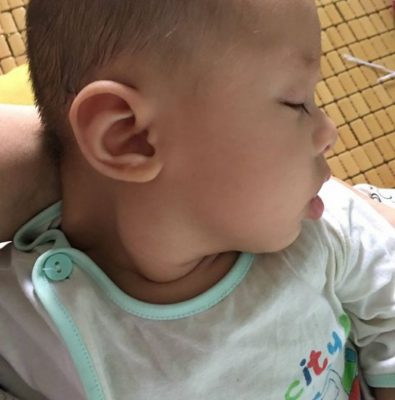 Trẻ sơ sinh bị tật vẹo cổ có chữa được không