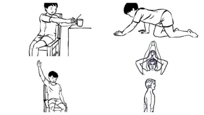 các bài tập vật lý trị liệu vẹo cột sống cho trẻ