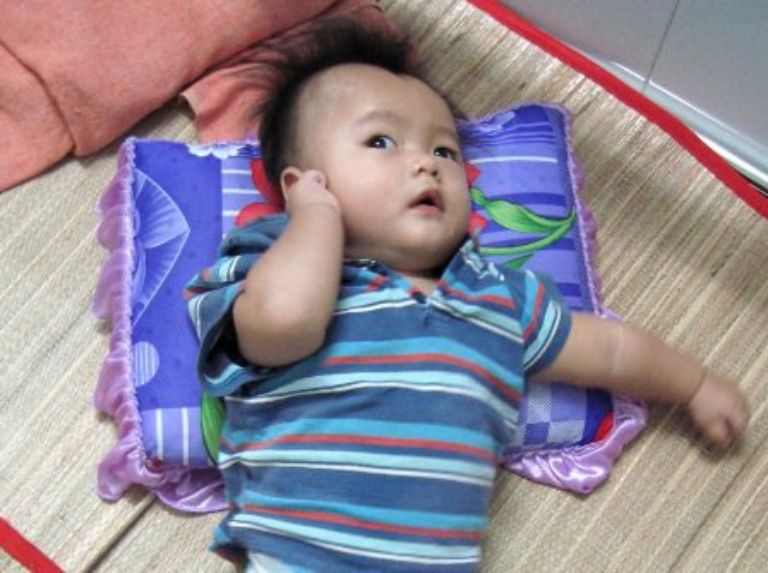 vật lý trị liệu cho trẻ bại não