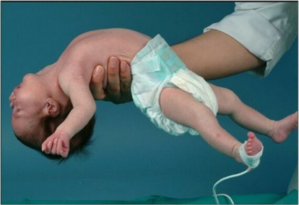 Giảm trương lực cơ là gì và có nguyên nhân từ đâu